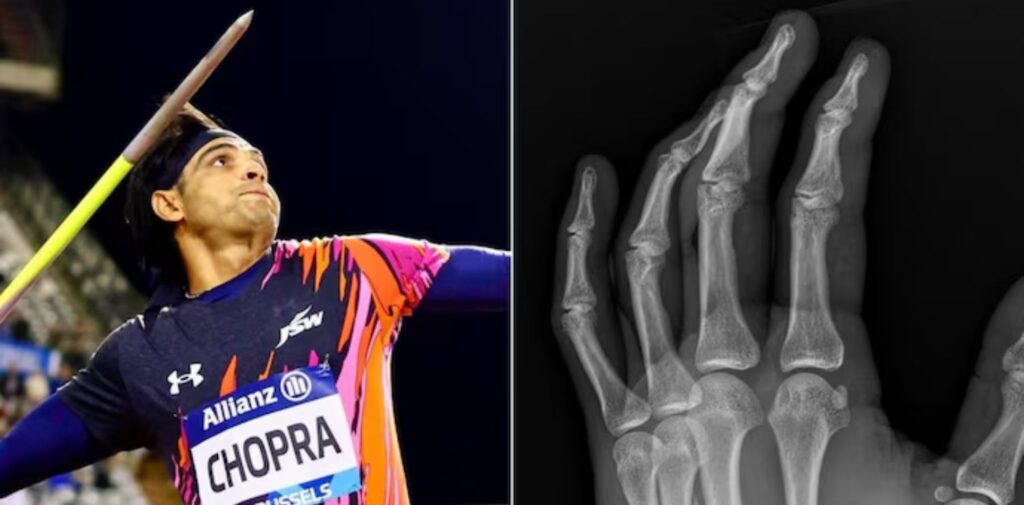 Neeraj-Chopra-Participates-in-Diamond-League-Final-with-a-Fractured-Hand-Finishes-Second-by-Just-One-Centimeter-Overcoming-Adversity-Nishant-Verma