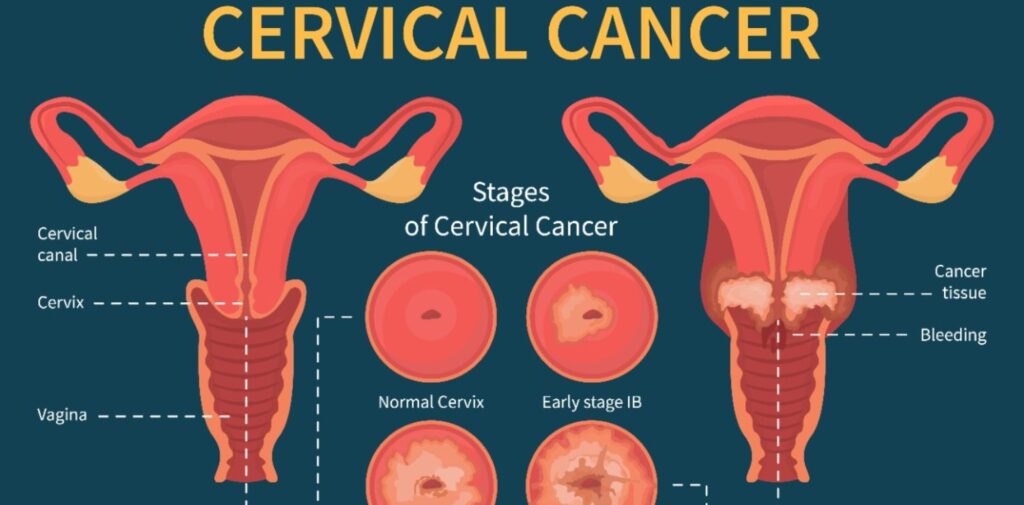 Cervical Cancer Awareness Month: Understanding, Preventing, and Fighting Cervical Cancer in India

